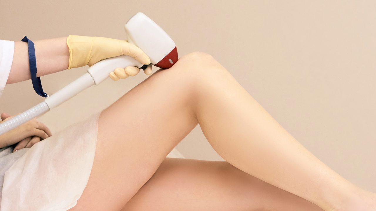 laser hair removal treatments