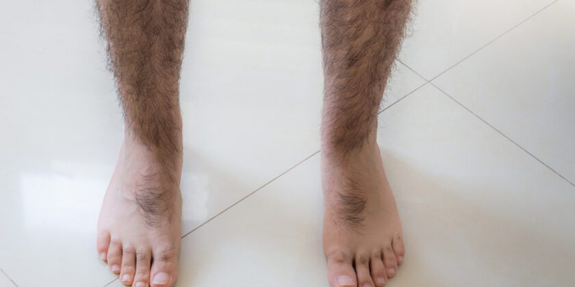 Unleashing Smooth Confidence: Leg Laser Hair Removal for Men