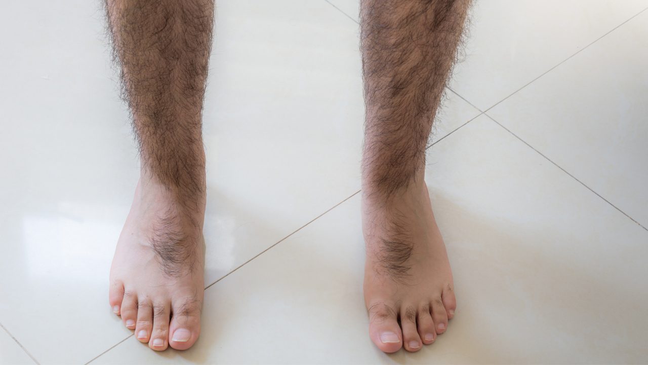 leg laser hair removal